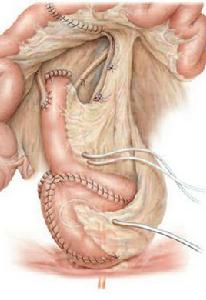 腸摺疊術 腸摺疊術