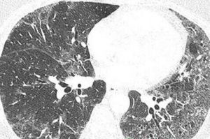 脫屑性間質肺炎