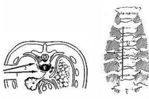 骶髂關節扭傷或半脫位