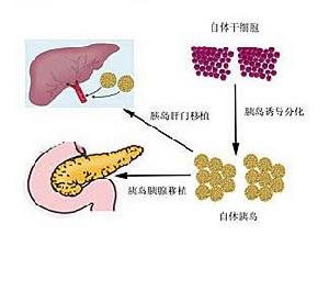 國際科學研究證明，胰島移植在肝