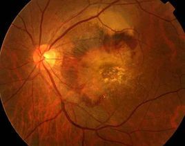 糖尿病眼病 糖尿病眼病