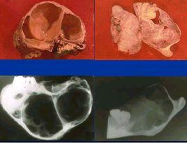 頜骨成釉細胞瘤
