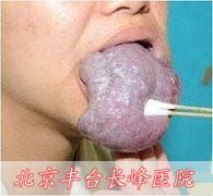舌部海綿淋巴血管瘤