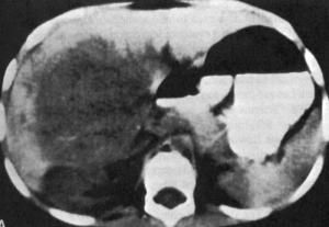 小兒神經母細胞瘤