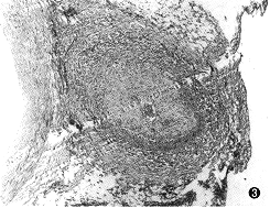 顱內占位性病變