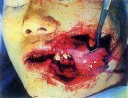 口腔頜面部軟組織挫裂傷 口腔頜面部軟組織挫裂傷