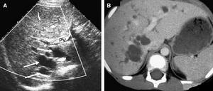 先天性肝內膽管囊狀擴張症