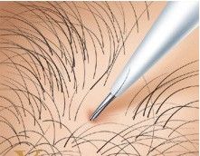 陰毛種植術 陰毛種植術