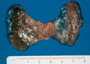 毒性瀰漫性甲狀腺腫 毒性瀰漫性甲狀腺腫