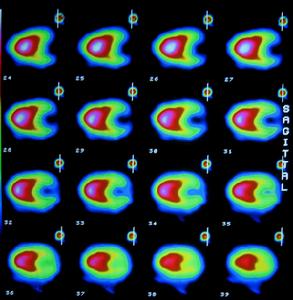 心尖肥厚型心肌病 心尖肥厚型心肌病