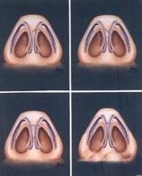 鼻部整形手術 鼻部整形手術