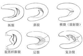 外側半月板 外側半月板