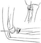 骨折固定術 骨折固定術
