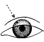 慢性閉角型青光眼