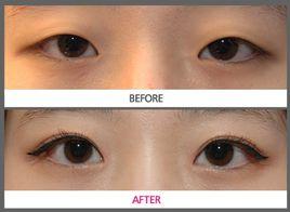 超微創雙眼皮 超微創雙眼皮