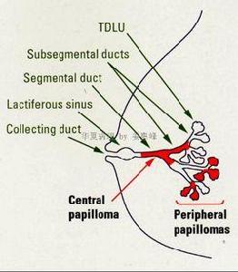 乳腺導管內乳頭狀癌