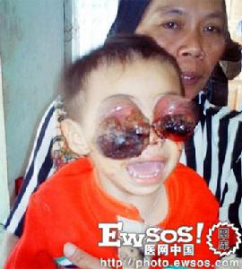 眼部腫瘤 眼部腫瘤