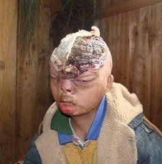 頭皮及顱骨燒傷