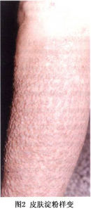 原發性皮膚澱粉樣變