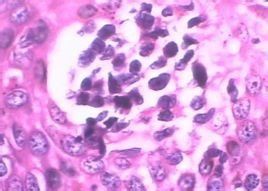 特異性陰道炎 特異性陰道炎