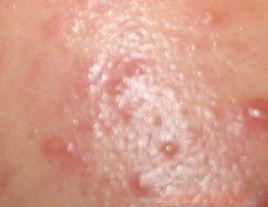 閉合性粉刺 閉合性粉刺