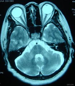遺傳性共濟失調