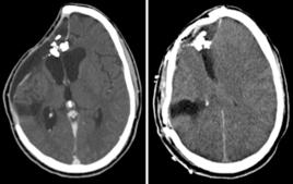 術後急性精神障礙 術後急性精神障礙