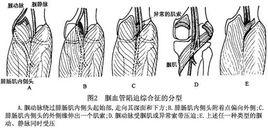 膕血管卡壓綜合徵