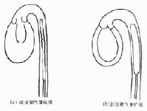 老年人心源性休克