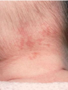 新生兒斑痣 新生兒斑痣