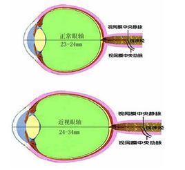 近視手術後遺症 近視手術後遺症