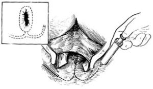 複雜肛瘺切除術 複雜肛瘺切除術