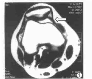 收肌結節 收肌結節