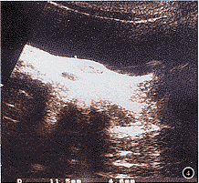 陰道內胚竇瘤 陰道內胚竇瘤