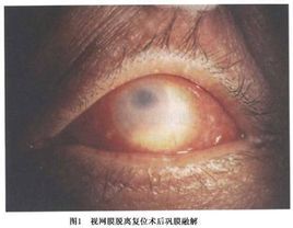 眼眶真菌病 眼眶真菌病