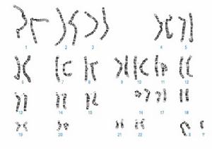 急性淋巴細胞白血病