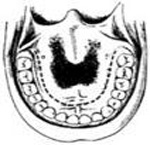 （圖）頸部血管瘤