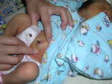 新生兒臍炎症狀