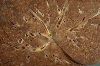 血行播散型肺結核