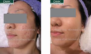 DMK痤瘡、閉合型粉刺療法