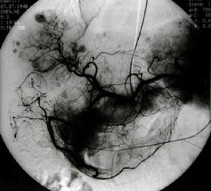 （圖）肝臟類癌