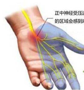 腕管炎 腕管炎