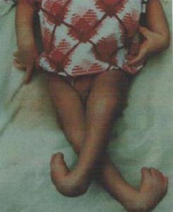 全身肌張力障礙 全身肌張力障礙