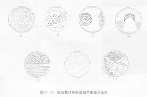 心包內惡性畸胎瘤