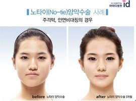 下頜角整形 下頜角整形