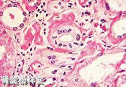 澱粉樣變腎病 澱粉樣變腎病