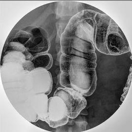 結腸雙對比造影 結腸雙對比造影