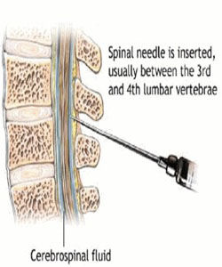 腰椎穿刺 腰椎穿刺