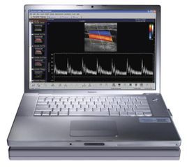 心臟彩超 心臟彩超