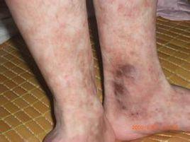 青斑樣血管炎 青斑樣血管炎